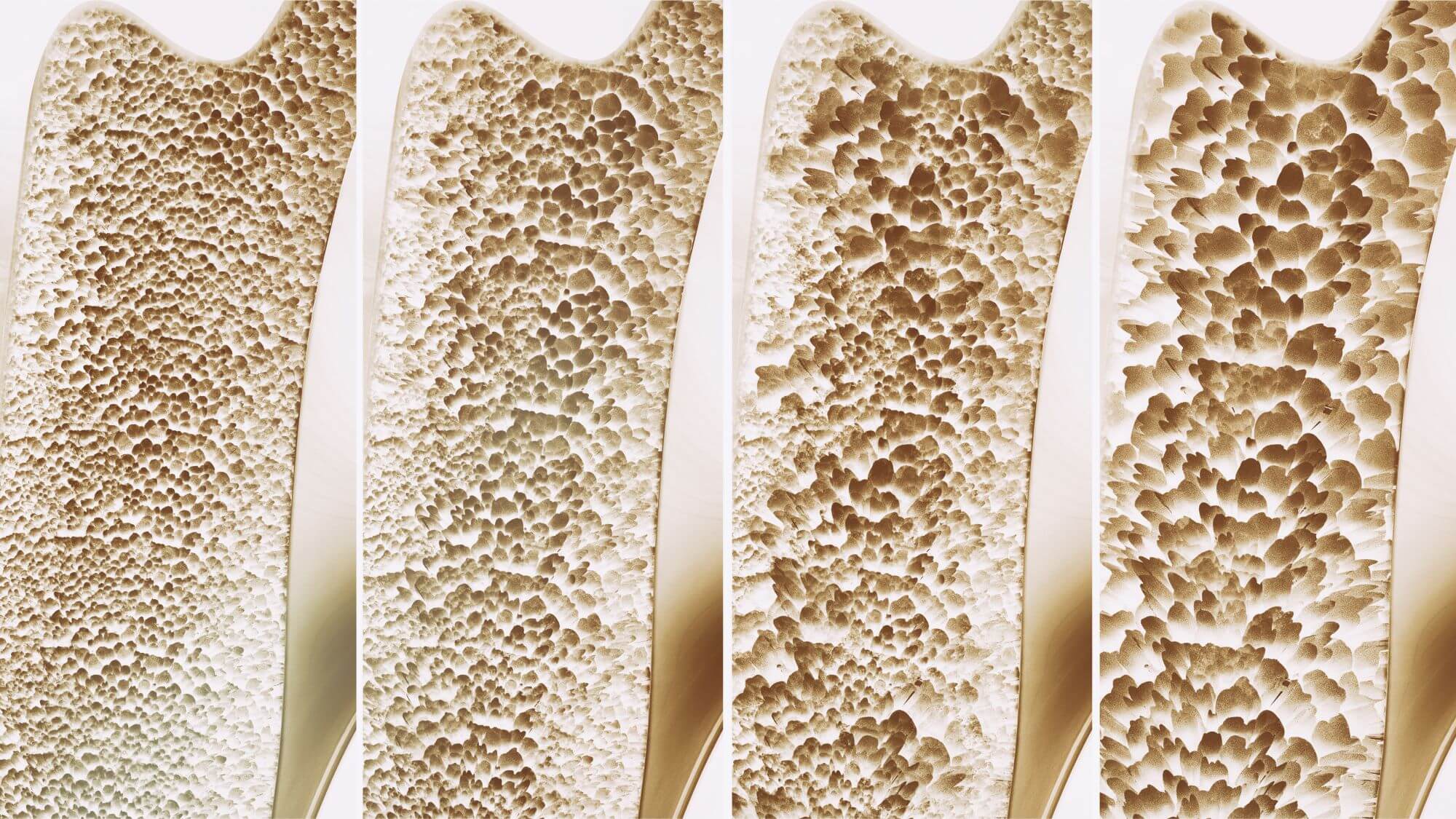 The Lifespan of Bone Health: How Our Bones Change Over Time